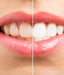 Photo comparing before and after of tooth whitening