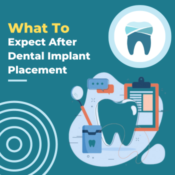 What To Expect After Dental Implant Placement What To Expect After Dental Implant Placement