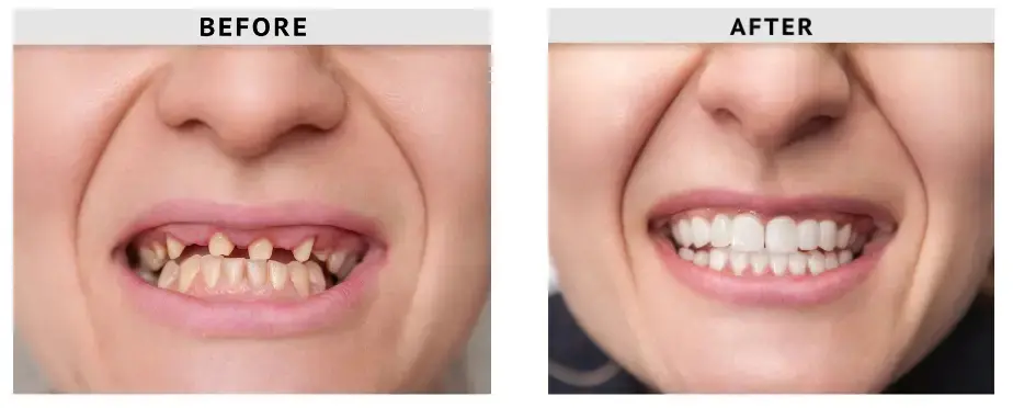 Before and after of getting dental implants